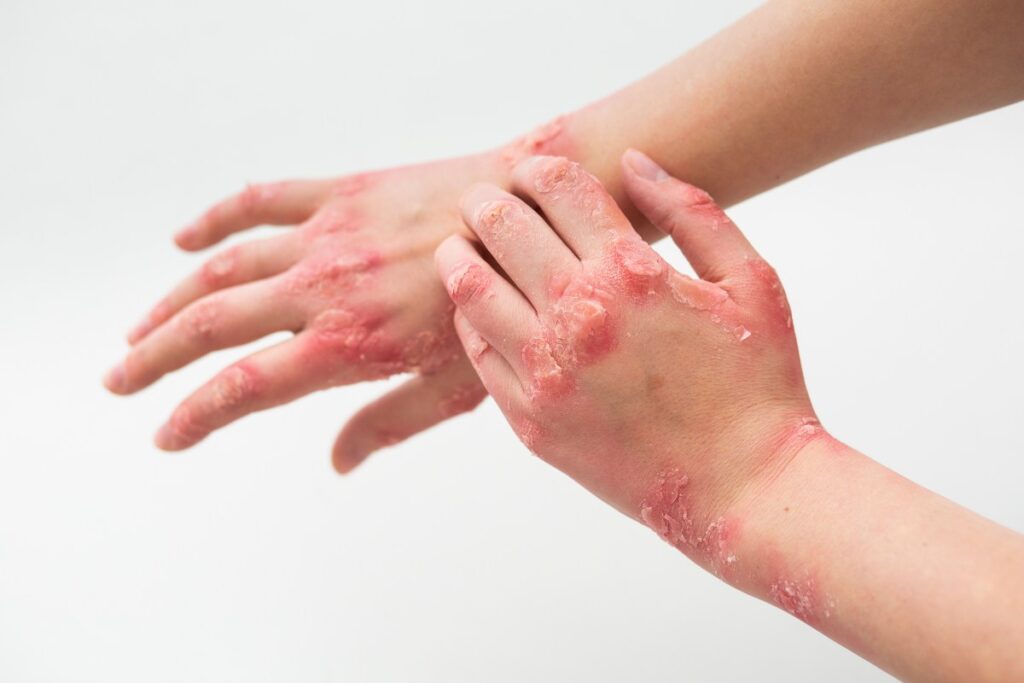 Eczedone skincare product designed to support healthy skin and help manage symptoms associated with dry, irritated skin.